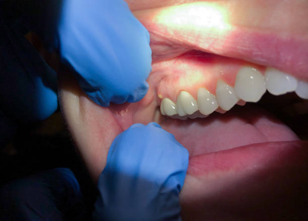Best Emergency Treatment for Dental Infections or Abscesses in Lakewood, CA